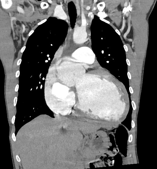 File:Aortic coarctation with aneurysm (Radiopaedia 74818-85828 C 49).jpg