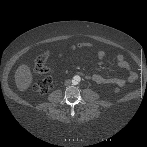File:Aortic dissection- Stanford A (Radiopaedia 35729-37268 C 28).jpg