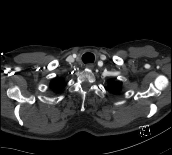 Aortic dissection (CTPA) (Radiopaedia 75506-86750 A 6).jpg