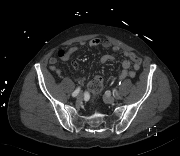 Aortic dissection (CTPA) (Radiopaedia 75506-86750 E 116).jpg