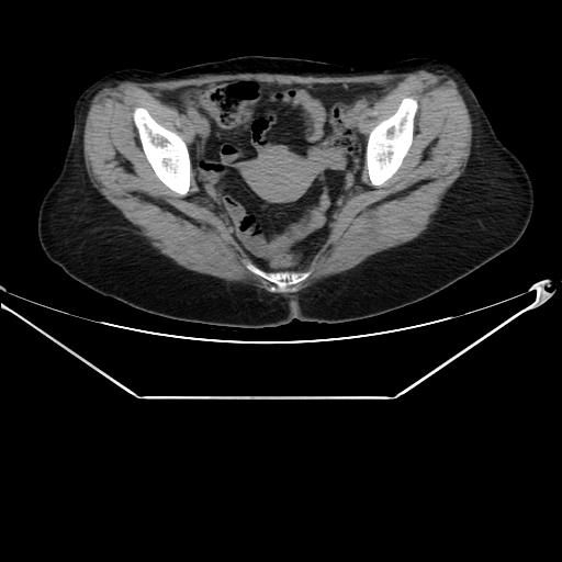 File:Aortic dissection (Radiopaedia 25350-25604 B 70).jpg