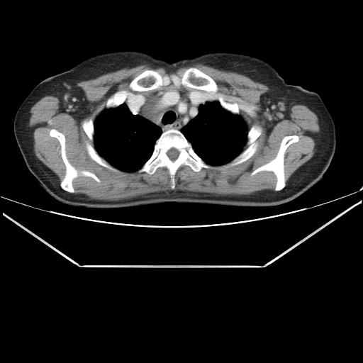 File:Aortic dissection (Radiopaedia 25350-25604 C 6).jpg