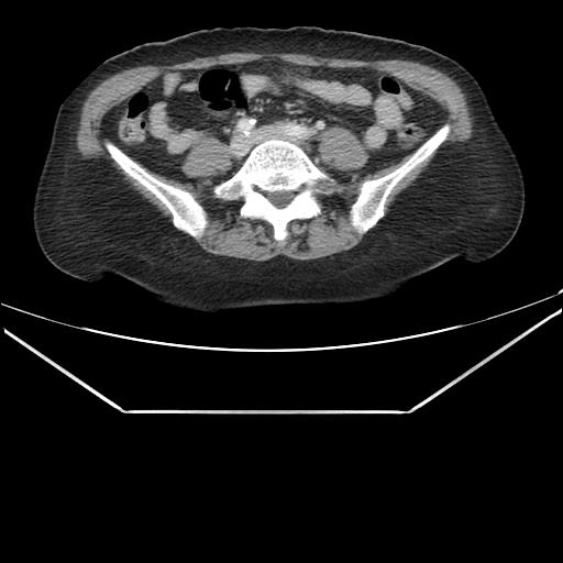 File:Aortic dissection (Radiopaedia 25350-25604 C 76).jpg
