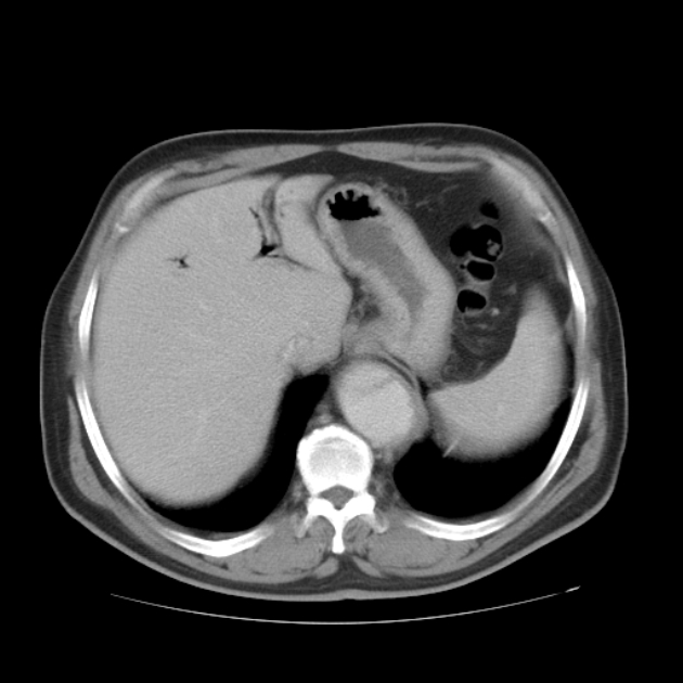 Aortic dissection (Radiopaedia 44411-48061 C 69).jpg