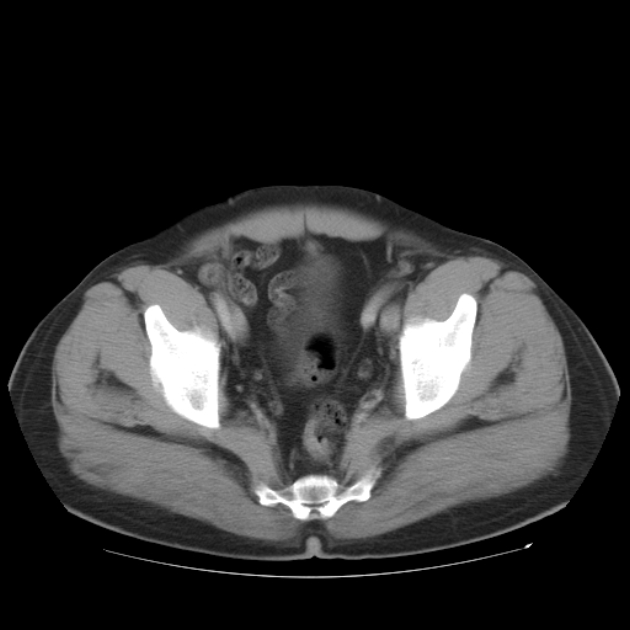 Aortic dissection (Radiopaedia 44411-48061 C 99).jpg