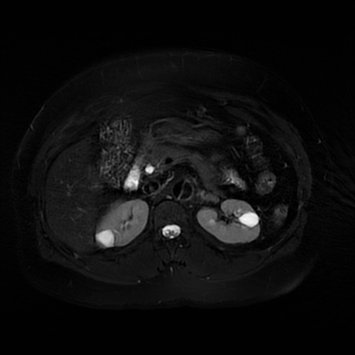 File:Aortic dissection (Radiopaedia 57969-64956 Axial T2 fat sat 28).jpg