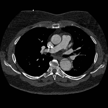 File:Aortic dissection (Radiopaedia 57969-64959 A 142).jpg