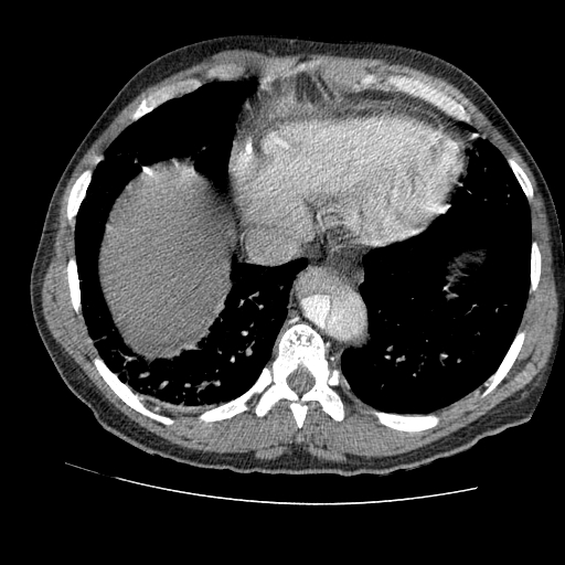 File:Aortic dissection - Stanford A -DeBakey I (Radiopaedia 28339-28587 B 79).jpg