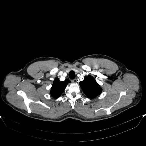File:Aortic dissection - Stanford type A (Radiopaedia 83418-98500 A 8).jpg