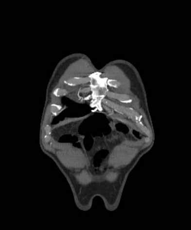 Aortic dissection - Stanford type B (Radiopaedia 73648-84437 B 7).jpg