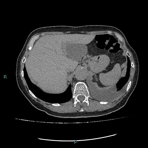File:Aortic dissection extended to lusory artery (Radiopaedia 43686-47136 Axial non-contrast 27).jpg
