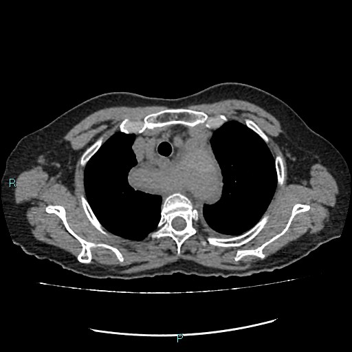 File:Aortic dissection extended to lusory artery (Radiopaedia 43686-47136 Axial non-contrast 6).jpg