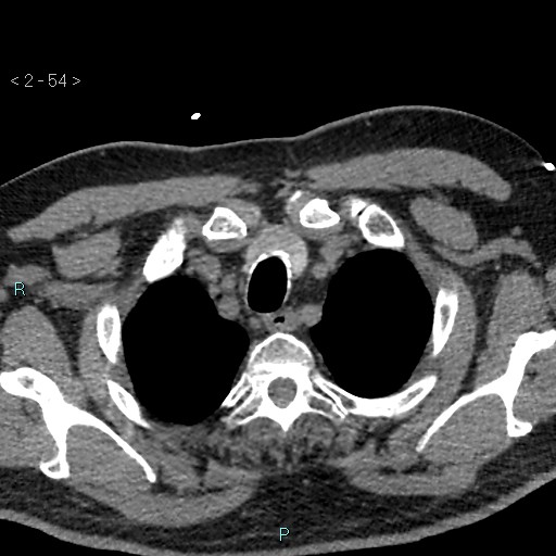 Aortic intramural hematoma (Radiopaedia 48463-53380 Axial non-contrast 24).jpg