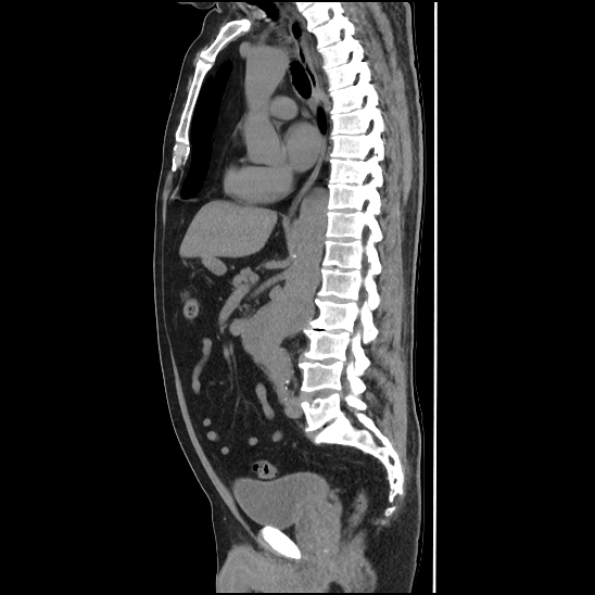 Aortic intramural hematoma (type B) (Radiopaedia 79323-92387 G 26).jpg