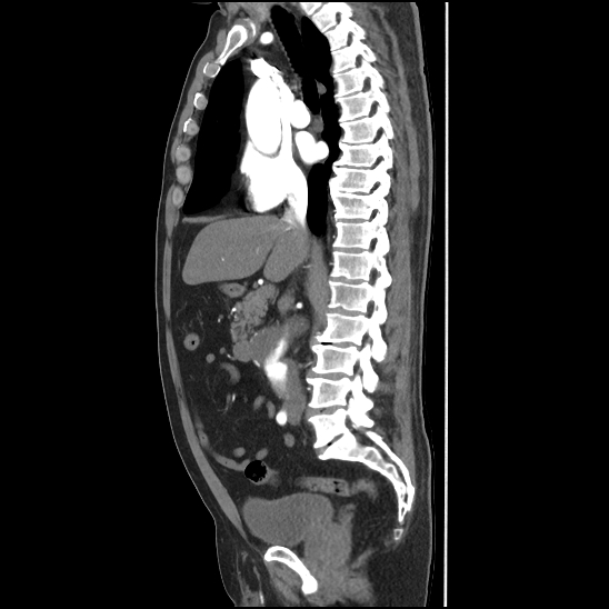 Aortic intramural hematoma (type B) (Radiopaedia 79323-92387 H 22).jpg