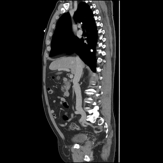 Aortic intramural hematoma (type B) (Radiopaedia 79323-92387 Sagittal C+ delayed 19).jpg