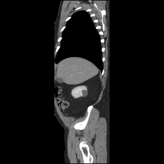 Aortic intramural hematoma (type B) (Radiopaedia 79323-92387 Sagittal C+ delayed 3).jpg