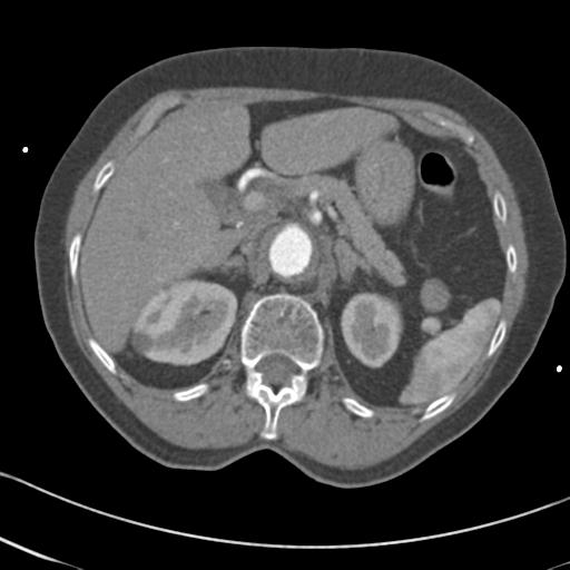 Aortic intramural hematoma from penetrating atherosclerotic ulcer (Radiopaedia 31137-31836 A 86).jpg