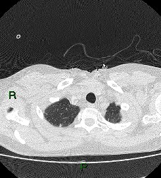 File:Aortic valve endocarditis (Radiopaedia 87209-103485 Axial lung window 16).jpg