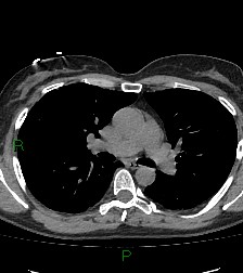 Aortic valve endocarditis (Radiopaedia 87209-103485 Axial non-contrast 46).jpg