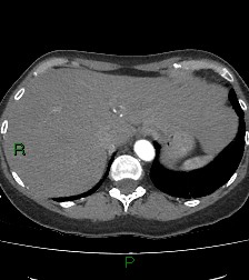 Aortic valve endocarditis (Radiopaedia 87209-103485 C 86).jpg