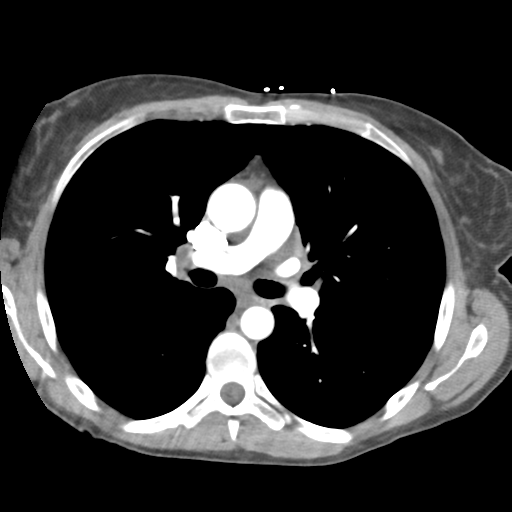 Aortic valve non-coronary cusp thrombus (Radiopaedia 55661-62189 B 22).png