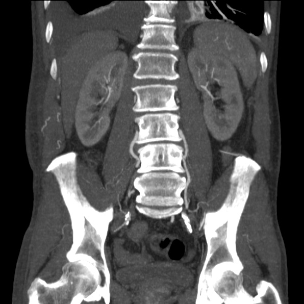 File:Aortoiliac occlusive disease (Radiopaedia 32134-33076 B 35).jpg