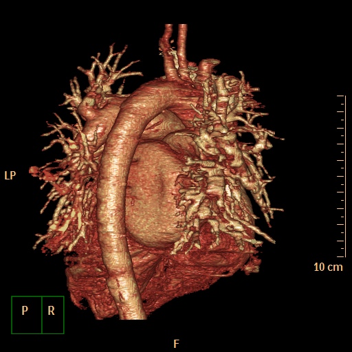 File:Aortopulmonary septal defect (Radiopaedia 41990-45013 3D reconstruction 13).jpg