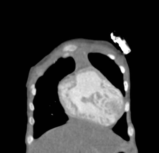File:Aortopulmonary window, interrupted aortic arch and large PDA giving the descending aorta (Radiopaedia 35573-37074 D 6).jpg