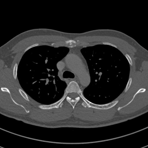 Apical lung mass mimic - neurogenic tumor (Radiopaedia 59918-67521 Axial bone window 28).jpg