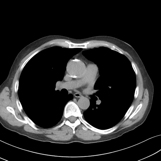 Apical pulmonary metastasis (Radiopaedia 46338-50754 B 32).png