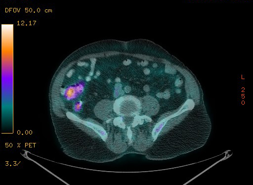 Appendiceal adenocarcinoma complicated by retroperitoneal abscess (Radiopaedia 58007-65041 Axial PET-CT 149).jpg