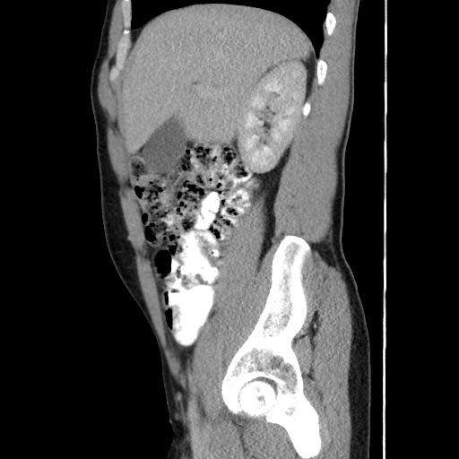 Appendicitis complicated by post-operative collection (Radiopaedia 35595-37114 C 24).jpg