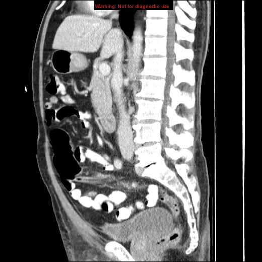 File:Appendicitis mass in inguinal hernia (Radiopaedia 26858-27029 C 26).jpg