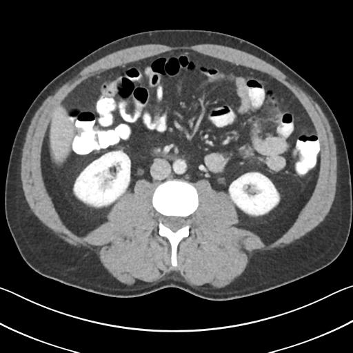 File:Appendicitis with cecal bar sign (Radiopaedia 31878-32830 B 41).jpg