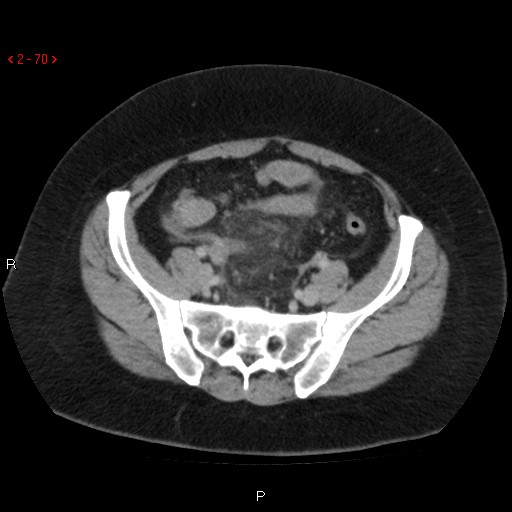 Appendicitis with microperforation- promontoric type (Radiopaedia 27268-27442 C 58).jpg