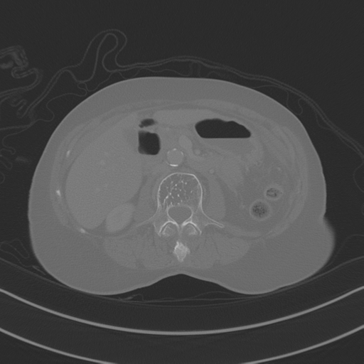 April fools' 2019- calcified peritoneal arachnoidosis (Radiopaedia 67273-76636 Axial bone window 16).png
