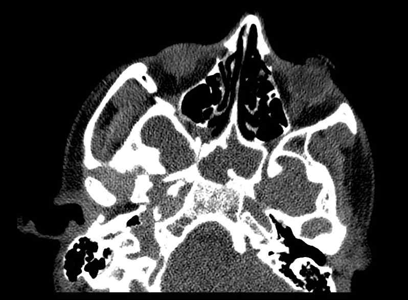 Arachnoid cyst- extremely large (Radiopaedia 68741-78450 Axial bone window 6).jpg