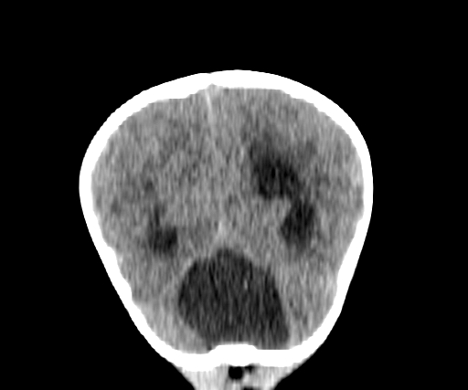 Arachnoid cyst-posterior fossa (Radiopaedia 88661-105370 Coronal non-contrast 63).jpg