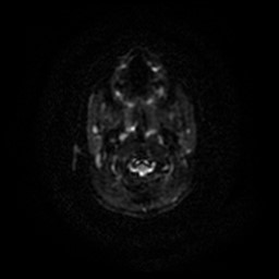 Arachnoid cyst - middle cranial fossa (Radiopaedia 86780-102938 Axial DWI 57).jpg