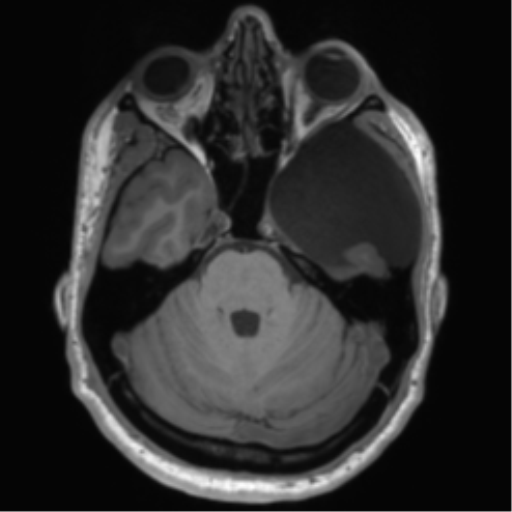 File:Arachnoid cyst with subdural hematoma (Radiopaedia 85892-101743 Axial T1 29).png