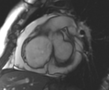 File:Arrhythmogenic right ventricular cardiomyopathy (Radiopaedia 69431-79307 Short axis cine 191).jpg