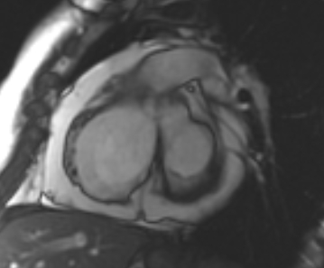 File:Arrhythmogenic right ventricular cardiomyopathy (Radiopaedia 69431-79307 Short axis cine 193).jpg