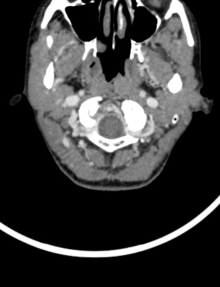 Arteriovenous malformation of the neck (Radiopaedia 53935-60062 B 3).jpg
