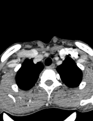 Arteriovenous malformation of the neck (Radiopaedia 53935-60062 B 48).jpg