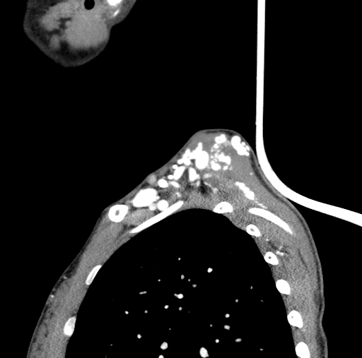 Arteriovenous malformation of the neck (Radiopaedia 53935-60062 C 6).jpg