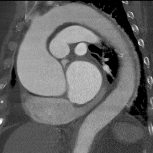 File:Ascending aortic aneurysm (Radiopaedia 20913-20846 A 16).jpg