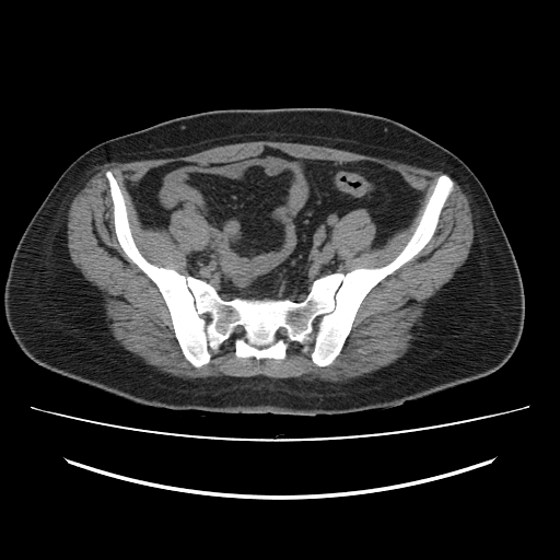File:Ascending retrocecal appendicitis with liver abscesses (Radiopaedia 60066-67615 Axial non-contrast 67).jpg