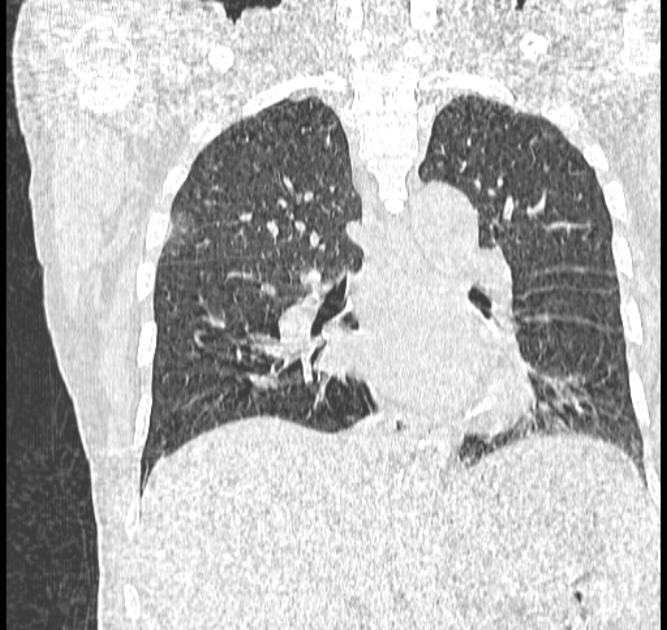 Aspergilloma (Radiopaedia 44592-48327 Coronal lung window 76).jpg