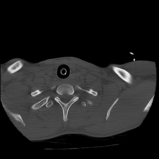 Atlanto-occipital dissociation (Traynelis type 1), C2 teardrop fracture, C6-7 facet joint dislocation (Radiopaedia 87655-104061 Axial bone window 87).jpg